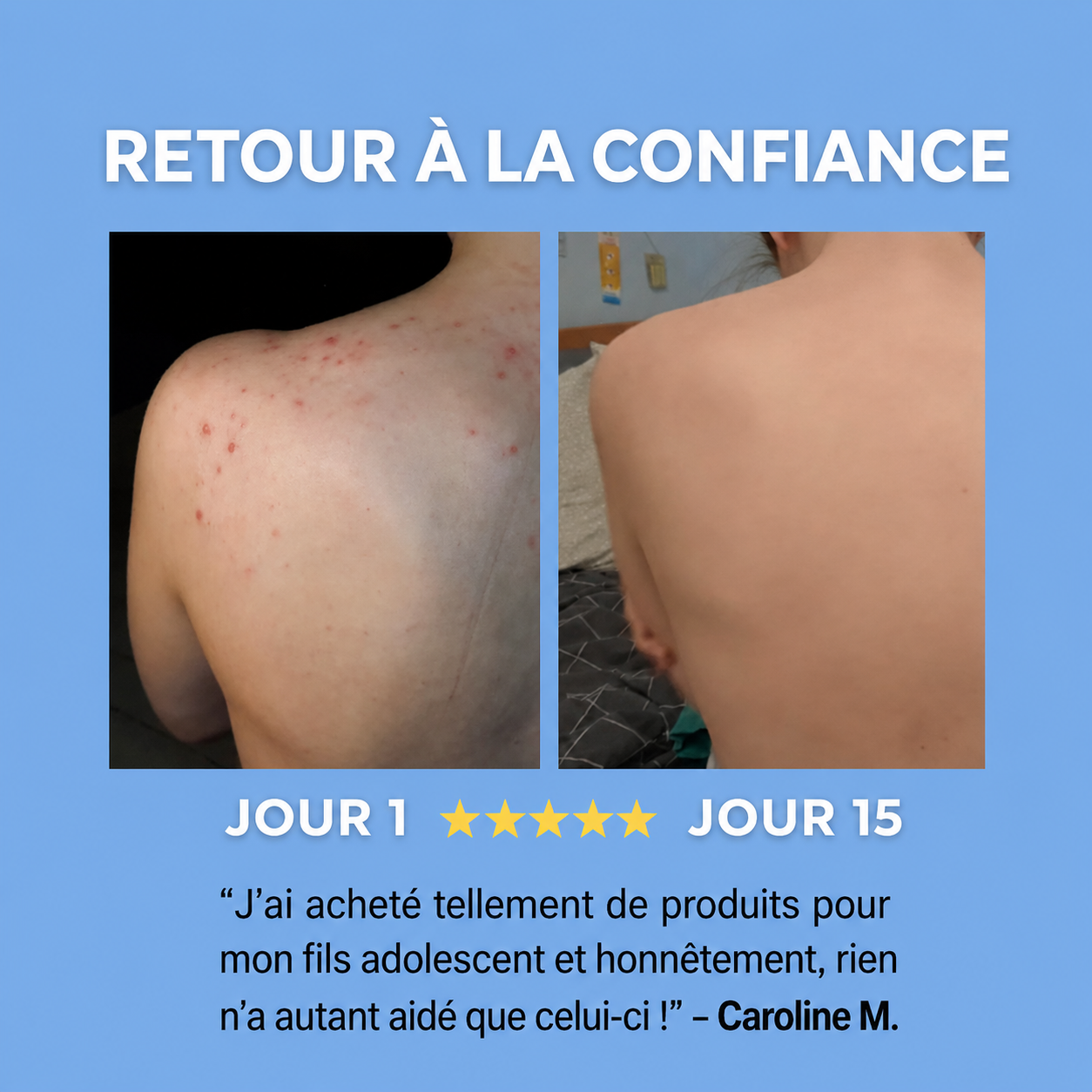 Savon anti-acné du dos